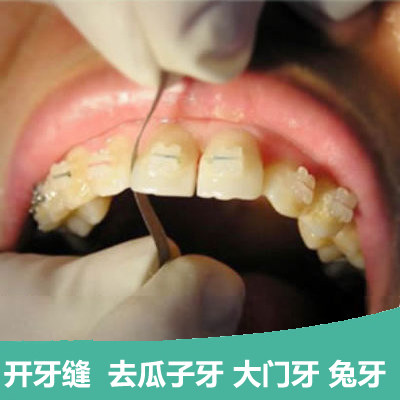开牙缝大兔牙虎牙打磨工具磨牙条成人牙齿矫正 保护漆防敏感